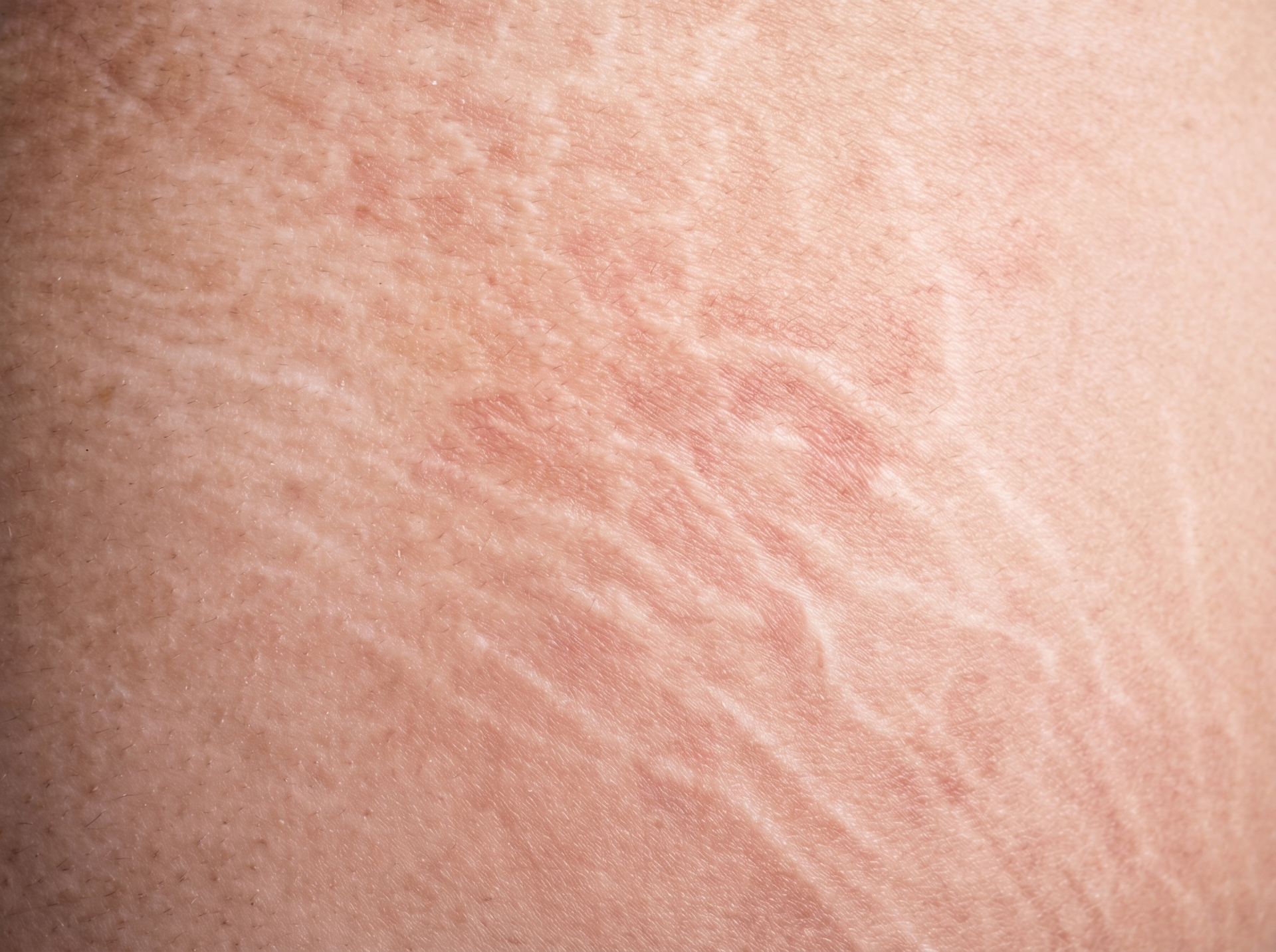 Close-up de pele com estrias, tratamento na New Laser, Toledo/PR