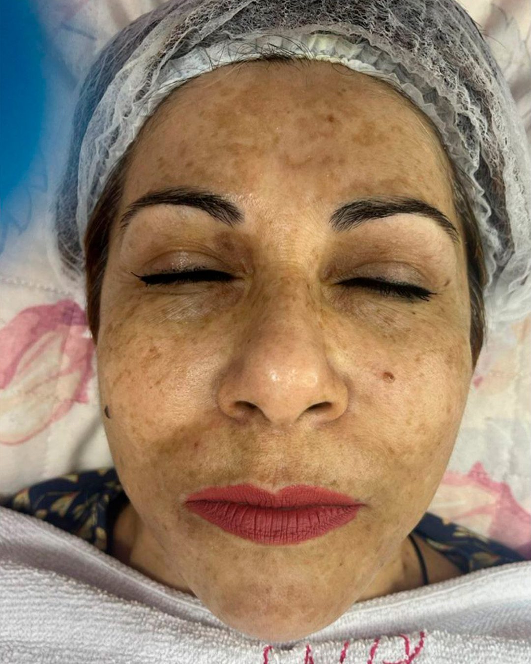 Antes, Resultado facial em manchas e textura, antes e depois autorizado pela cliente