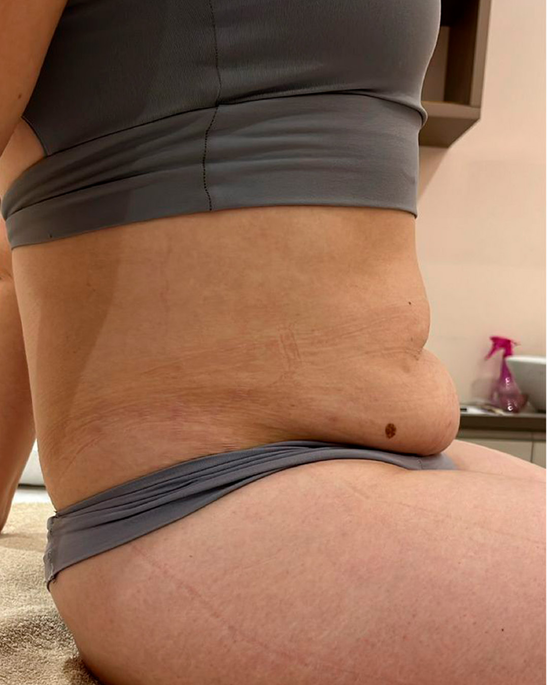 Antes, Resultado corporal na cintura, antes e depois autorizado pela cliente