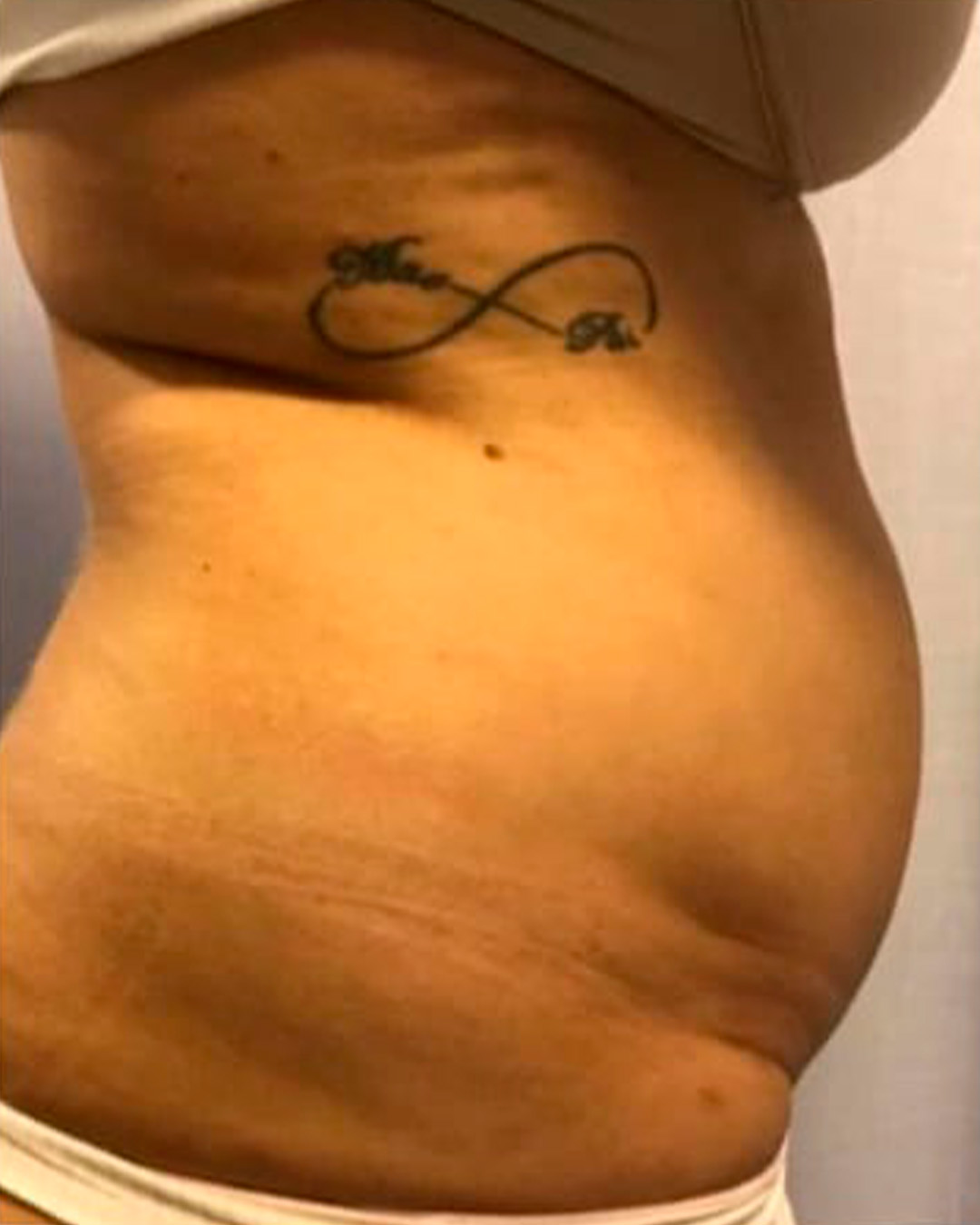 Antes, Resultado corporal no abdômen, antes e depois autorizado pela cliente
