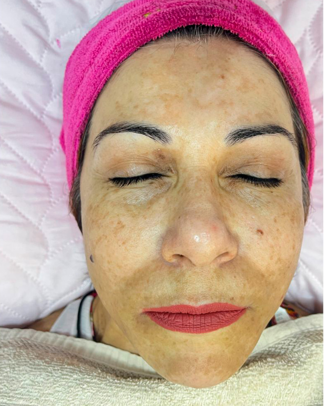 Depois, Resultado facial em manchas e textura, antes e depois autorizado pela cliente