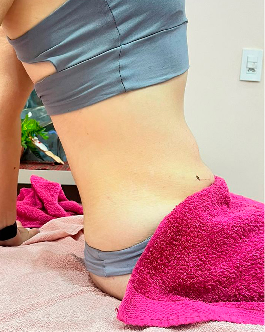 Depois, Resultado corporal na cintura, antes e depois autorizado pela cliente