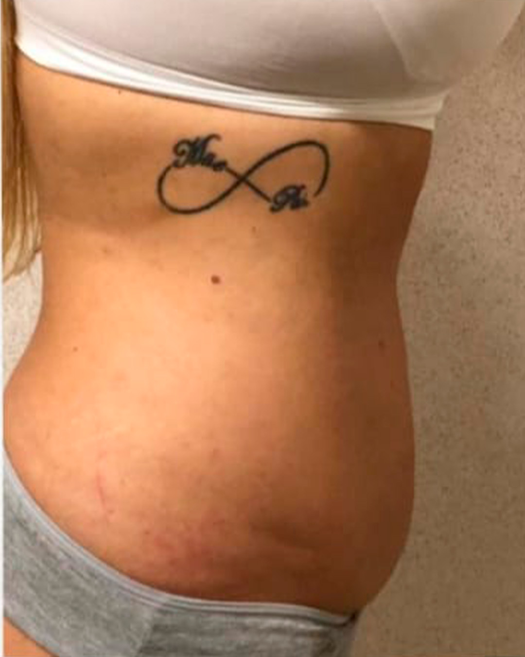 Depois, Resultado corporal no abdômen, antes e depois autorizado pela cliente